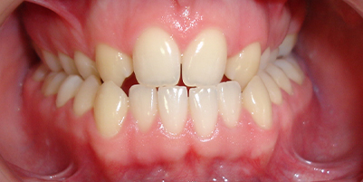 Przed leczeniem - krzywe zęby