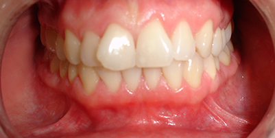 Stłoczenie zębów szczęki i żuchwy