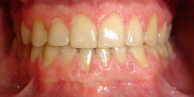 Stan po leczeniu i bondingu zębów