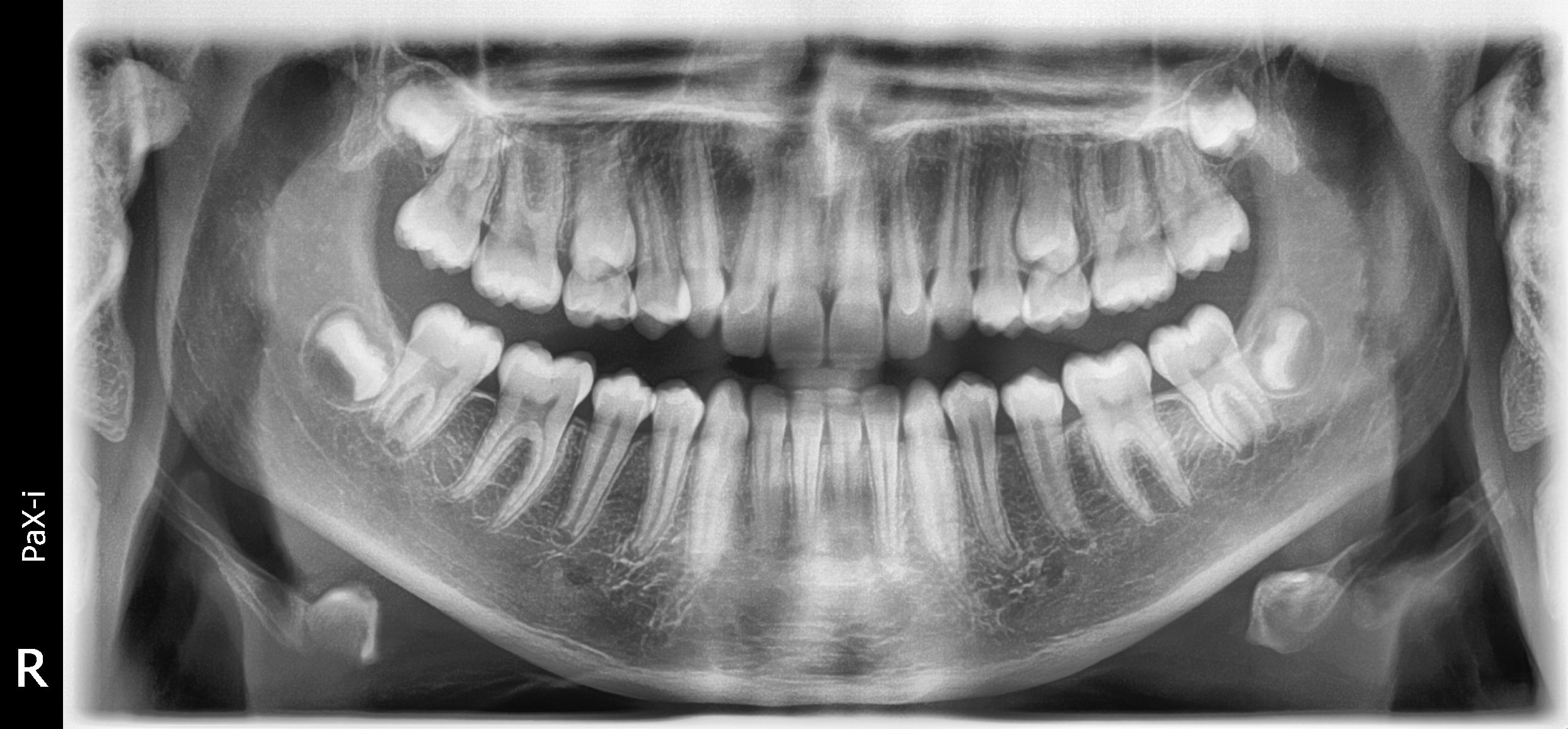 Zdjęcie zębów pantomograficzne.
